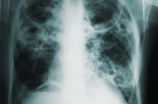 如何预防肺栓塞，让你的生活更健康