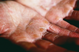 手足癣常见病例及治疗方法